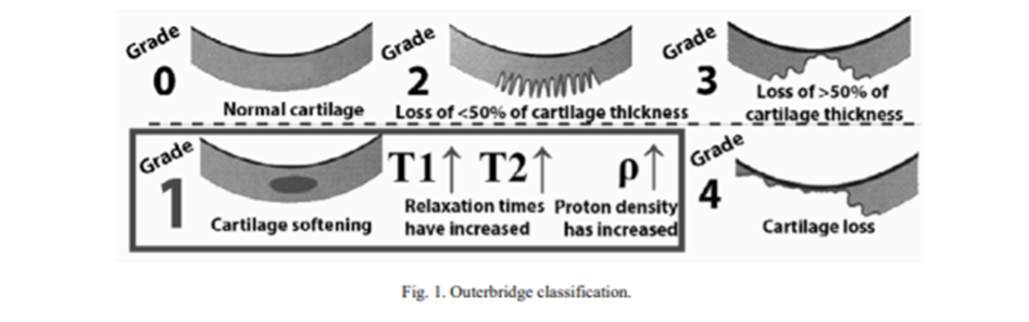 Voorbeeld van kraakbeendegeneratie op beeldvorming